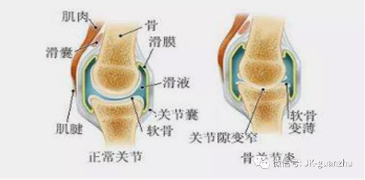 软骨磨有哪些症状