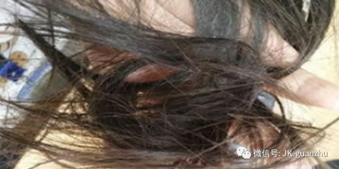 女性　身上的毛发与健康