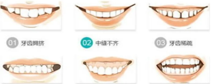 引起牙齿畸形的3大因素