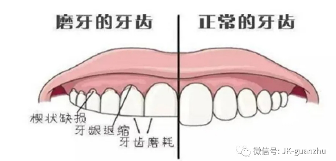 磨牙不可忽视！早预防早治疗