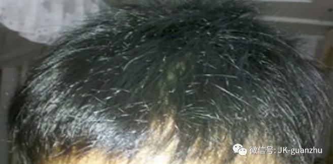 肝脏好不好？看看头发就能知道