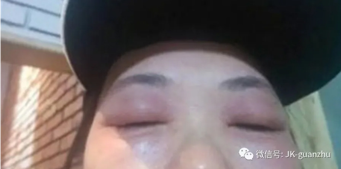 哪些原因引起眼睛浮肿？