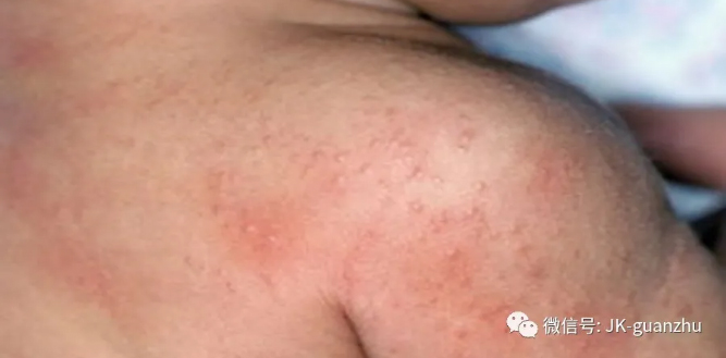 夏季皮肤红痒是痱子？当心是皮炎！