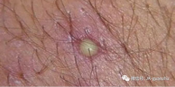 毛囊炎怎么治疗？