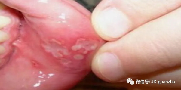 口腔溃疡发生的原因有哪些呢？