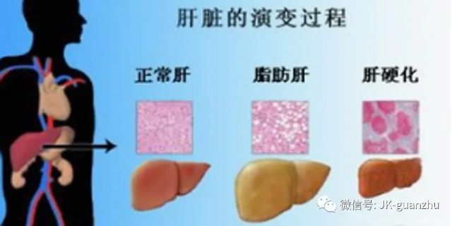 引起脂肪肝的原因