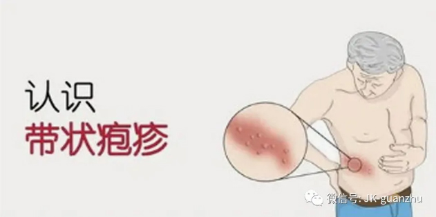 带状疱疹如何做好护理？