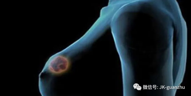 乳腺癌的7大征兆 早发现早治疗