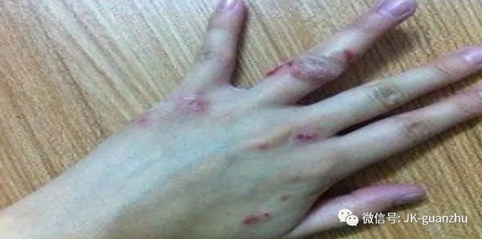 大人长了湿疹之后应该怎么办？