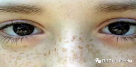 女性要如何预防雀斑