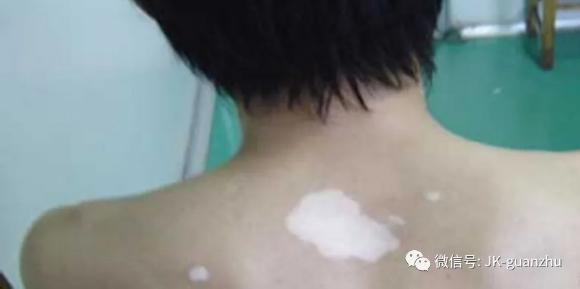 白癜风的痕迹可以纹身来遮盖吗？