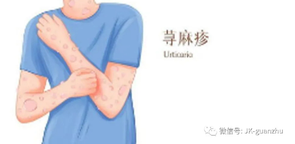 冬季积极防治荨麻疹